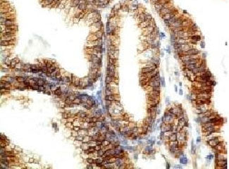 Formalin-fixed, paraffin-embedded human colon carcinoma stained with E-Cadherin antibody (CDH1/1525)