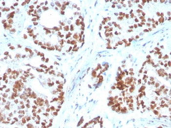 IHC staining of FFPE human prostate carcinoma with NKX3.1 antibody. HIER: boil tissue sections in pH