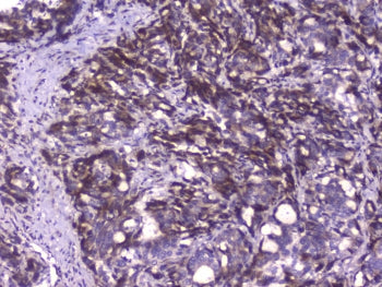 IHC staining of FFPE human stomach cancer with Capicua antibody at 1ug/ml. HIER: boil tissue section