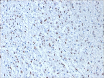 IHC testing of FFPE human mesothelioma with WT1 antibody cocktail (clone WT1/857 + 6F-H2). Required 
