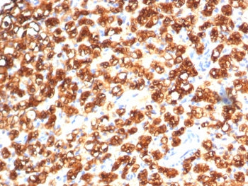 IHC staining of FFPE human kidney cancer with TPH1 antibody (clone TPH1/7662). HIER: boil tissue sec
