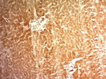 IHC: Formalin-fixed, paraffin-embedded human hepatocellular carcinoma stained with Glypican-3 antibo