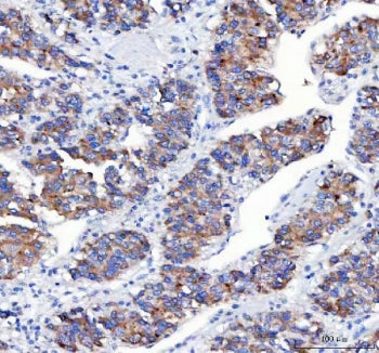 IHC staining of FFPE human liver cancer tissue with Amyloid-like protein 2 antibody. HIER: boil tiss