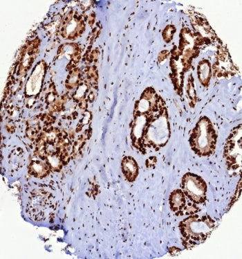 IHC staining of FFPE human prostate carcinoma tissue with PCNA antibody (clone PCNA/8633R). HIER: bo