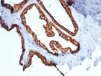 IHC staining of FFPE human prostate carcinoma tissue with recombinant KRT18 antibody (clone rKRT18/7