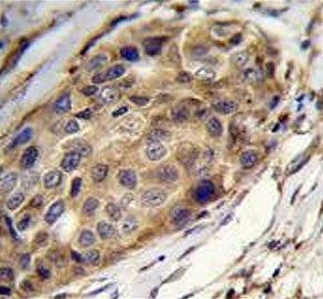 IHC testing of FFPE human breast carcinoma tissue with Slingshot homolog 3 antibody. HIER: steam sec