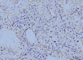 IHC staining of FFPE human renal clear cell carcinoma tissue with Annexin VI antibody. HIER: boil ti