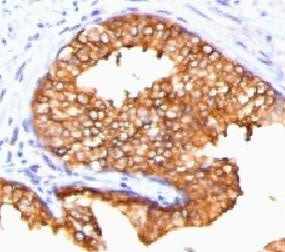 IHC testing of FFPE human prostate carcinoma and ODC antibody (clone ORN255-1). Required HIER: boil 
