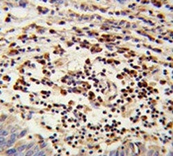 IHC testing of FFPE human lung carcinoma tissue with Mitochondrial amidoxime reducing component 2 an
