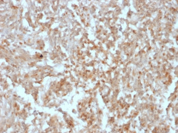IHC testing of FFPE human gastrointestinal stromal tumor (GIST) with ANO1 antibody (clone rDG1/447).