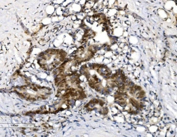 IHC staining of FFPE human rectal cancer with VPRBP antibody. HIER: boil tissue sections in pH8 EDTA