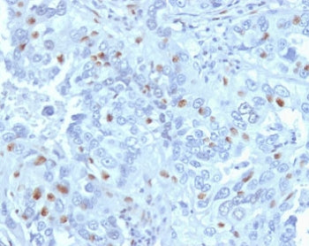 IHC testing of FFPE human endometrial carcinoma with CCNA2 antibody (clone CNA2-1). Required HIER: s