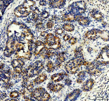 IHC staining of FFPE human breast cancer tissue with STXBP4 antibody, HRP-secondary and DAB substrat