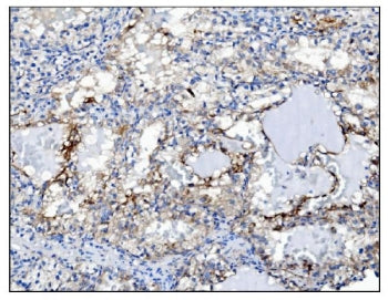 IHC staining of FFPE human renal clear cell carcinoma tissue with PGP9.5 antibody. HIER: boil tissue