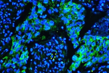 Immunofluorescent staining of FFPE human lung cancer tissue with Caveolin-1 antibody (green) and DAP
