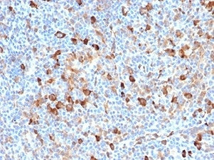 IHC staining of FFPE human Hodgkin's lymphoma with FSCN1 antibody (clone FSCN1/7209). HIER: boil tis