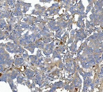 IHC staining of FFPE human ovarian cancer with Afamin antibody. HIER: boil tissue sections in pH8 ED