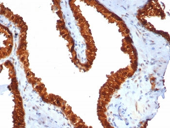 IHC staining of FFPE human prostate carcinoma tissue with TACSTD2 antibody (clone TACSTD2/7348R). HI