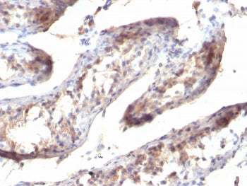 IHC staining of FFPE human testicular carcinoma with TGF-a antibody (clone SPM357). HIER: pH 9 10mM 