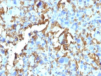 IHC: Formalin-fixed, paraffin-embedded human Histiocytoma stained with HLA-DRB antibody (clone HLA-D