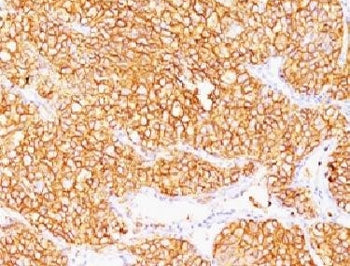 IHC: Formalin-fixed, paraffin-embedded human renal cell carcinoma stained with CA9 antibody (SPM314)