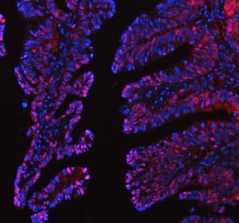 Immunofluorescent staining of FFPE human intestinal cancer tissue with Leukotriene A-4 hydrolase ant
