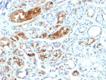 IHC testing of FFPE human breast carcinoma stained with Mammaglobin antibody (MGB/2000). Required HI