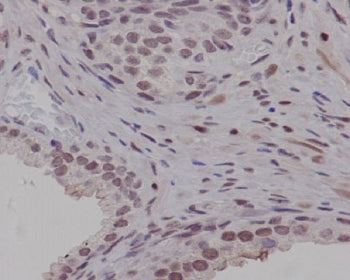 IHC staining of FFPE human prostate carcinoma with PIM1 antibody. HIER: boil tissue sections in pH6,