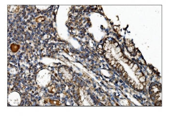 IHC staining of FFPE human gallbladder adenocarcinoma tissue with CTLA4 antibody. HIER: boil tissue 