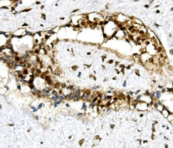 IHC staining of FFPE human breast cancer with U2AF65 antibody. HIER: boil tissue sections in pH8 EDT