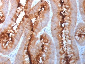 IHC staining of FFPE human colon carcinoma tissue with CEA antibody. HIER: boil tissue sections in p