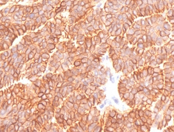 IHC testing of FFPE human basal cell carcinoma and recombinant EpCAM antibody (clone EPM17-5R). Requ