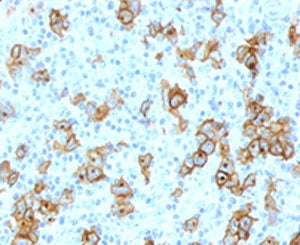 IHC testing of formalin-fixed, paraffin-embedded human Hodgkin's lymphoma stained with CD30 antibody