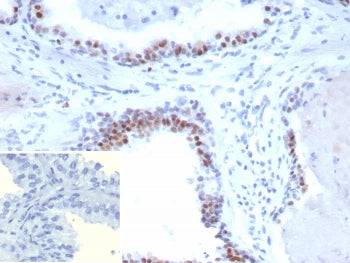 IHC staining of FFPE human prostate carcinoma tissue with recombinant Androgen Receptor V7 antibody 