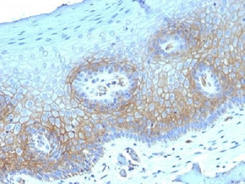 IHC testing of FFPE human cervical carcinoma with Thrombomodulin antibody (clone THBD/1782). HIER: b