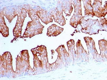 IHC testing of FFPE human prostate cancer with FOLH1 antibody. Required HIER: boil tissue sections i