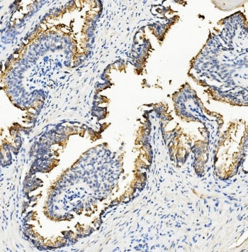 IHC staining of FFPE human prostate cancer with RNH1 antibody. HIER: boil tissue sections in pH8 EDT