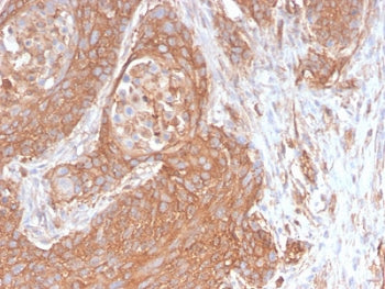 IHC testing of FFPE human pancreatic cancer with recombinant Spectrin beta III antibody (clone SPTBN