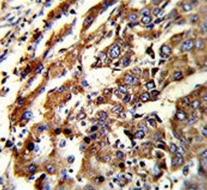 IHC testing of FFPE human hepatocellular carcinoma tissue with Endoplasmic reticulum resident protei