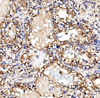 IHC staining of FFPE human renal clear cell carcinoma tissue with Glycogen synthase 1 antibody. HIER