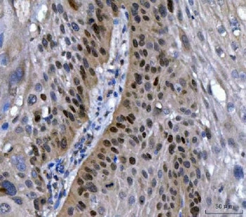 IHC staining of FFPE human laryngeal squamous cell carcinoma tissue with SOX2 antibody. HIER: boil t