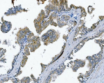 IHC staining of FFPE human prostate cancer with Poliovirus Receptor antibody. HIER: boil tissue sect