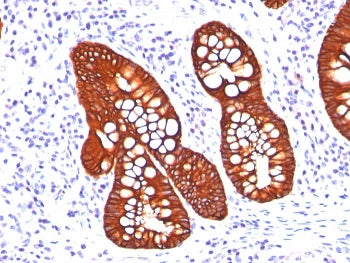IHC: Formalin-fixed, paraffin-embedded human colon carcinoma stained with Cytokeratin 19 antibody (A