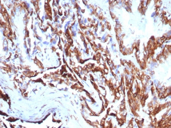 IHC staining of FFPE human prostate carcinoma tissue with recombinant KRT7 antibody (clone rKRT7/876