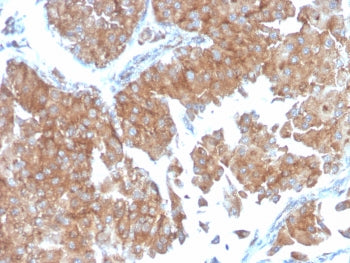 IHC testing of FFPE human urothelial carcinoma with SERBP1 antibody (clone SERBP1/3498). Required HI
