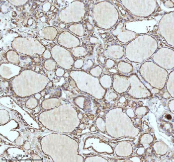 Immunohistochemical staining of IDH3B using anti-IDH3B antibody. IDH3B was detected in a paraffin-em