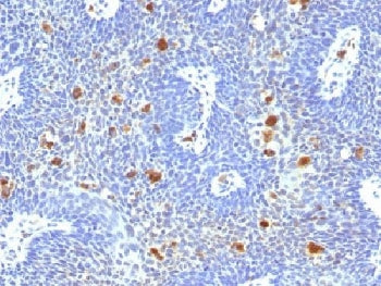IHC testing of FFPE human cervix with HPV-16 E6 antibody (clone HPV16/1296). Required HIER: boil tis