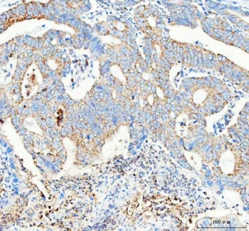 IHC staining of FFPE human colorectal adenocarcinoma tissue with Pellino 2 antibody. HIER: boil tiss