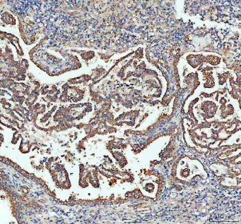 IHC staining of FFPE human lung cancer tissue with Sacsin antibody, HRP-labeled secondary and DAB su