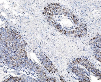 IHC staining of FFPE human liver cancer tissue with CHCHD10 antibody. HIER: boil tissue sections in 